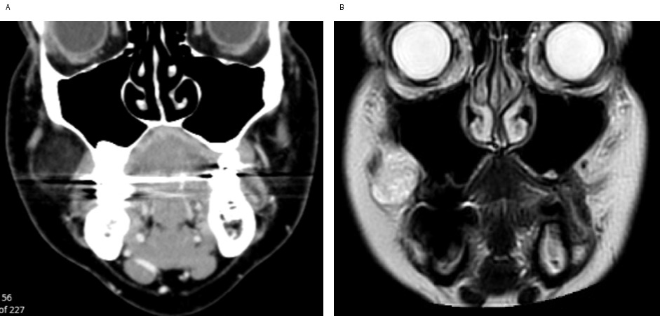magnetic resonance imaging showing a well-circumscribed, non-encapsulated lesion of fat attenuation/signal in the right buccal region