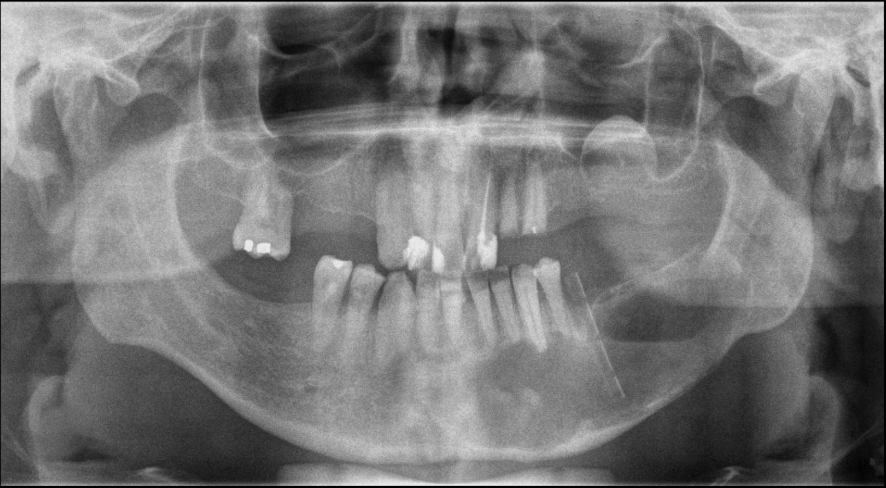 Panoramic xray demonstrating decompression tube in situ
