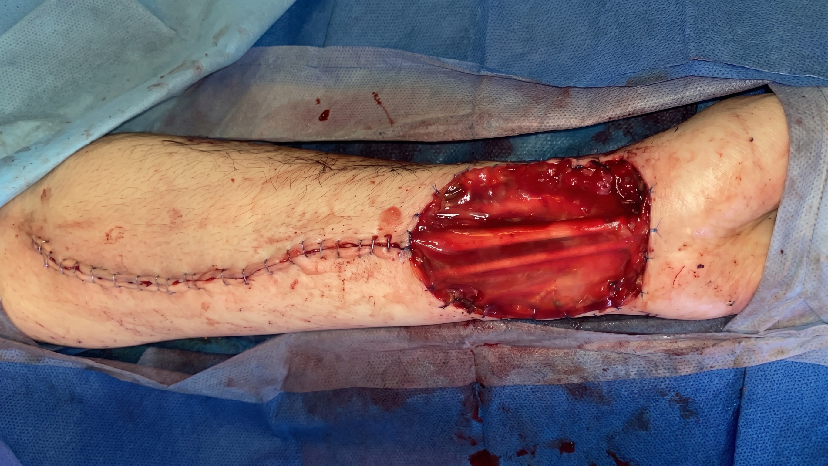 Immediate postoperative result of a Double-layer Integra® with split-thickness skin graft (STSG) at the donor site of RFFF.